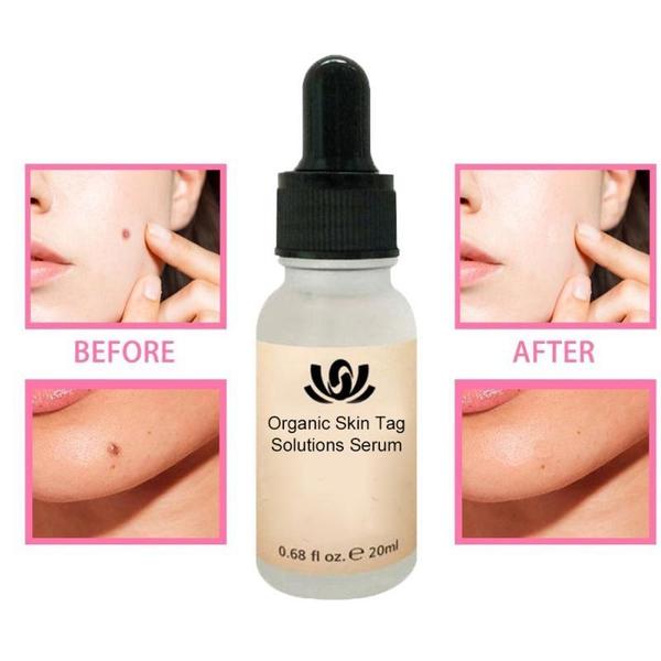 SkinTagRemover™ - Organisches Serum zur Lösung von Hautflecken